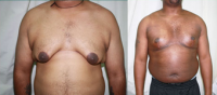 30 Years Young Man From Aftrican Origin Suffered From Loose And Hanging Male Breast (Gynecomastia ) By Dr. Ashok Govila, FRCS, MCh, MS, Dubai Plastic Surgeon