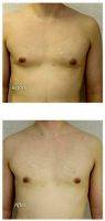 18-24 Year Old Man Treated With Male Breast Reduction By Dr Nadia P. Blanchet, MD, Richmond Plastic Surgeon
