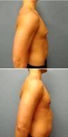 20 Year Old Man Treated With Male Breast Reduction With Dr. Tyler Angelos, MD, Columbus Plastic Surgeon