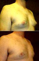 25 Year Old Man Treated With Male Breast Reduction With Dr Rolando Morales Jr, MD, Houston Plastic Surgeon