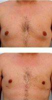 28 Year Old Man Treated With Male Breast Reduction By Doctor Paul Vitenas, Jr., MD, Houston Plastic Surgeon
