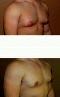 33 Year Old Man Treated With Male Breast Reduction With Dr. Gregory Turowski, MD, PhD, FACS, Chicago Plastic Surgeon