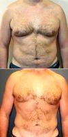 45-54 Year Old Man Treated With Male Breast Reduction By Dr. John Mancoll, MD, Virginia Beach Plastic Surgeon