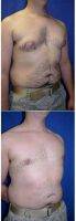 Dr Carlos Mata, MD, MBA, FACS, Scottsdale Plastic Surgeon 25-34 Year Old Man Treated With Male Breast Reduction