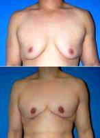 Dr. Matthew G. Stanwix, MD, FACS, Richmond Plastic Surgeon Gynecomastia Surgery (male Breast Reduction)