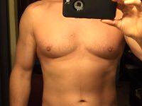 Gynecomastia Is A Medical Condition Marked By Enlargement Of A Man's Chest