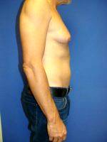 Gynecomastia May Occur During Infancy And Puberty In Normally-developing Boys