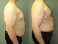 Gynecomastia Results Before And After