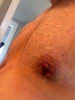 Gynecomastia Surgery Nipple Scar (1)