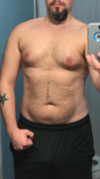 The Excessive Growth Of Breast Tissue In Adult Men Is Genuine Gynecomastia