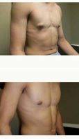 18-24 Year Old Man Treated With Gynecomastia Surgery With Dr William Andrade, MD, Toronto Plastic Surgeon