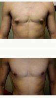 18-24 Year Old Man Treated With Male Breast Reduction With Dr William Andrade, MD, Toronto Plastic Surgeon