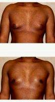 21 Year Old Man Treated With Male Breast Reduction By Dr. Babak Dadvand, MD, Los Angeles Plastic Surgeon