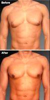 25-34 Year Old Man Treated With Male Breast Reduction By Dr Steven Teitelbaum, MD, Los Angeles Plastic Surgeon
