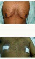 25-34 Year Old Man Treated With Male Breast Reduction By Dr. Hasan Ali, MBBS, MRCS, MS, Dubai Plastic Surgeon