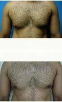 25-34 Year Old Man Treated With Male Breast Reduction With Dr Atul Kesarwani, MD, FRCSC, Toronto Plastic Surgeon