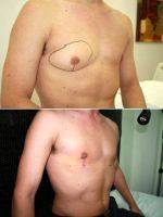 27 Years British Male Suffering From Male Breast Enlargement On Right Side For Past 5 Years By Doctor Ashok Govila, FRCS, MCh, MS, Dubai Plastic Surgeon