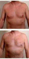 33 Year Old Woman Treated With Male Breast Reduction With Doctor Vincent N. Zubowicz, MD, Atlanta Plastic Surgeon