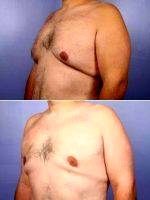 37 Yr Old Male Weight Loss Patient By Dr. Grant Stevens, MD, Los Angeles Plastic Surgeon