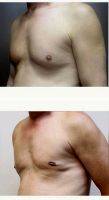 45-54 Year Old Man Treated With Male Breast Reduction By Doctor Mansour Bendago, FRCSC, Toronto Plastic Surgeon