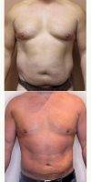 45-54 Year Old Man Treated With Male Breast Reduction By Dr. Mansour Bendago, FRCSC, Toronto Plastic Surgeon
