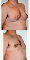 45 Y.o. Man With Gynecomastia, Received Scarless Male Breast Reduction And Liposuction Contouring By Doctor Peter Bray, MD, Toronto Plastic Surgeon