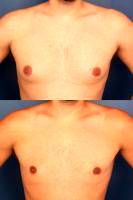 Before And After Male Breast Reduction In New Zealand