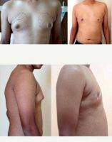 Doctor Ashok Govila, FRCS, MCh, MS, Dubai Plastic Surgeon 18 Year Old Man Treated With Male Breast Reduction