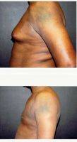 Doctor Fara Movagharnia, DO, FACOS, Atlanta Plastic Surgeon 35-44 Year Old Man Treated With Male Breast Reduction