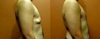 Doctor Jake Lim, MBBS, FRACS, Sydney Plastic Surgeon Male Breast Reduction