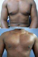 Doctor Julian Gordon, MD, Atlanta Plastic Surgeon 35-44 Year Old Man Treated With Male Breast Reduction