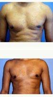 Doctor Lisa M. DiFrancesco, MD, Atlanta Plastic Surgeon 35-44 Year Old Man Treated With Male Breast Reduction