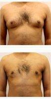 Doctor Mansour Bendago, FRCSC, Toronto Plastic Surgeon 35-44 Year Old Man Treated With Male Breast Reduction ( Gynecomastia)