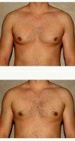 Dr Babak Dadvand, MD, Los Angeles Plastic Surgeon 32 Year Old Man Treated With Male Breast Reduction