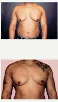 Dr Fara Movagharnia, DO, FACOS, Atlanta Plastic Surgeon 25-34 Year Old Man Treated With Male Breast Reduction