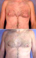 Dr Grant Stevens, MD, Los Angeles Plastic Surgeon Male Breast Reduction