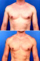 Dr Marcus Crawford, MD, Atlanta Plastic Surgeon Male Breast Reduction