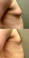 Dr Mathew A. Plant, MD, FRCSC, Toronto Plastic Surgeon 25-34 Year Old Man Treated With Male Breast Reduction