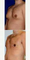 Dr Peter Bray, MD, Toronto Plastic Surgeon Enlarged Male Breasts (gynecomastia) Treated With Male Breast Reduction, Invisible Scars
