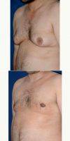 Dr Peter Bray, MD, Toronto Plastic Surgeon Male Breast Enlargement (gynecomastia) Treated With Male Breast Reduction, Invisible Scars