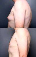 Dr. Angela Keen, MD, Salt Lake City Plastic Surgeon Male Breast Reduction