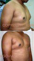 Dr. Ashok Govila, FRCS, MCh, MS, Dubai Plastic Surgeon Male Breast Reduction (1)