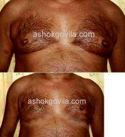 Dr. Ashok Govila, FRCS, MCh, MS, Dubai Plastic Surgeon Male Breast Reduction (2)