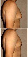 Dr. Babak Dadvand, MD, Los Angeles Plastic Surgeon 23 Year Old Man Treated With Male Breast Reduction