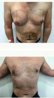 Dr. Hasan Ali, MBBS, MRCS, MS, Dubai Plastic Surgeon 35-44 Year Old Man Treated With Male Breast Reduction