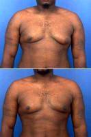 Dr. Marcus Crawford, MD, Atlanta Plastic Surgeon Male Breast Reduction