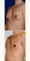 Enlarged Male Breasts (gynecomastia) Treated With Male Breast Reduction, Invisible Scars By Doctor Peter Bray, MD, Toronto Plastic Surgeon