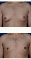 Gynecomastia Surgery Using BodyTite Liposuction For Stubborn Gynecomastia By Dr Peter Bray, MD, Toronto Plastic Surgeon