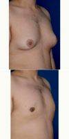 Male Breast Reduction Using BodyTite Liposuction For Stubborn Gynecomastia By Dr Peter Bray, MD, Toronto Plastic Surgeon