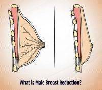 What Is Male Breast Reduction Photo